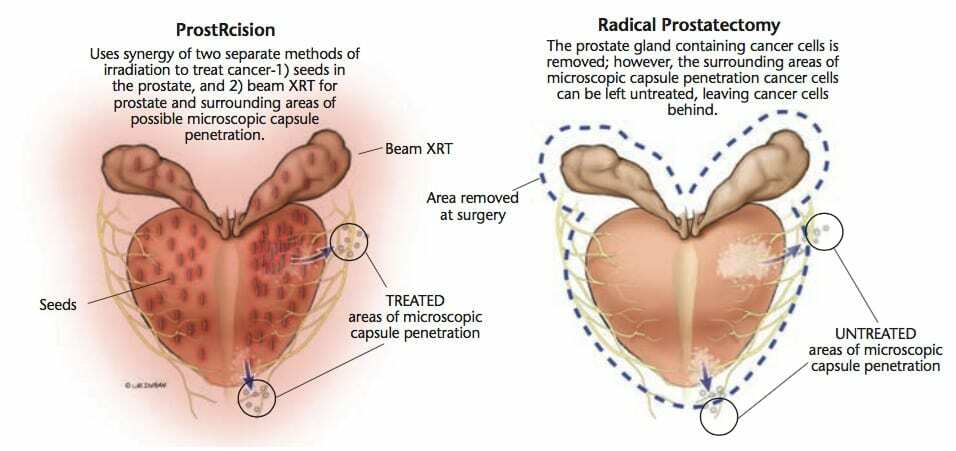 Comparison-of-ProstRcision-and-Radical-Prostatectomy