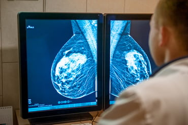 Breast Cancer Screening: What is the BI-RADS Score and What Does it Mean for You?