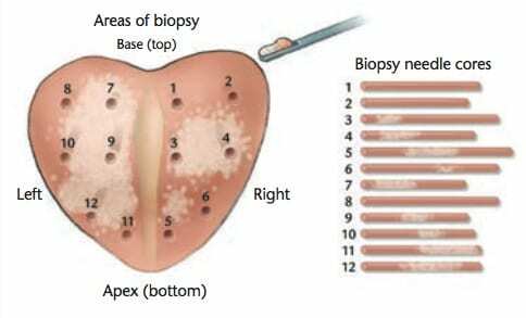 The-12-needle-cores-taken-during-prostate-biopsy