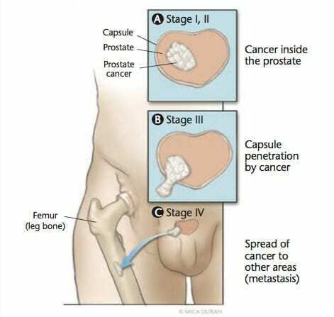 The-three-steps-of-prostate-cancer-growth