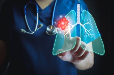 Biomarker Testing for Non-Small Cell Lung Cancer