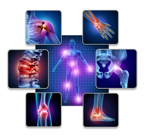 osteoarthritis radiation